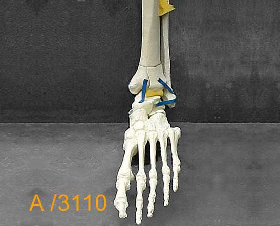 Ankle Large Left – Full length tibia and fibula 4-part Pilon fracture A3110