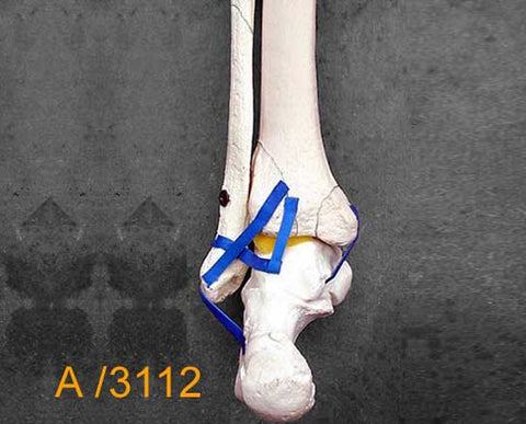 Ankle Large Left – Distal tibia and fibula with multiple fractures A3112