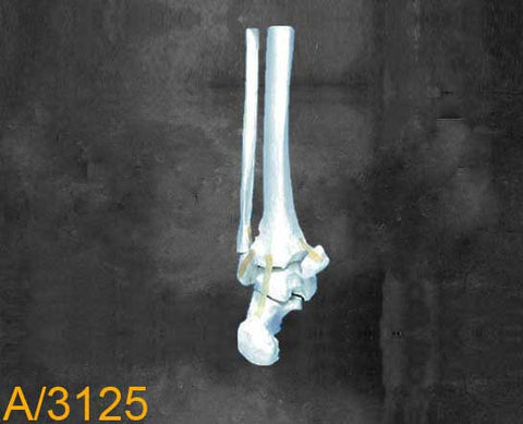 Ankle Large Left –Distal tibia and fibula. with oblique fibula fracture A3125