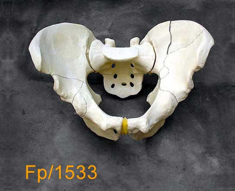 Full Pelvis -  Largewith column fracture FP1533