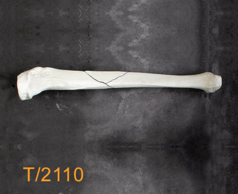 Tibia Large Left butterfly midshaft fracture T2110