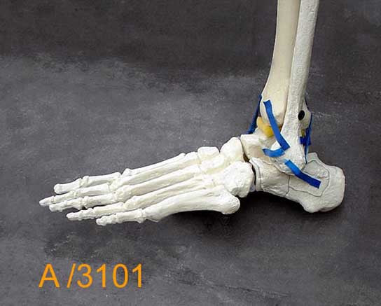 Ankle Large Left – Distal tibia and fibula,Talar fracture A3101