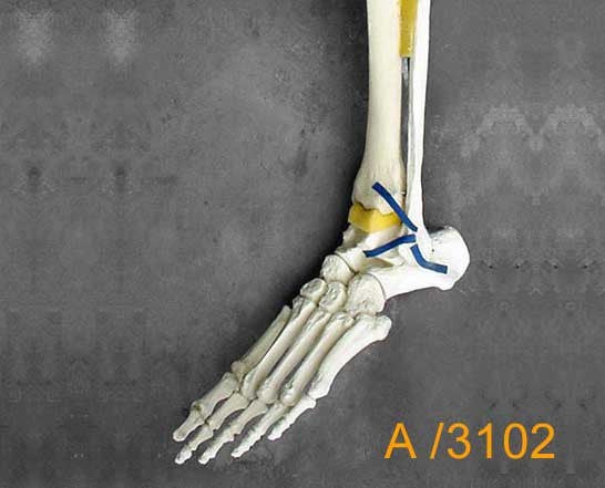 Ankle Large Left Distal Tib/Fib with NO fractures A3102