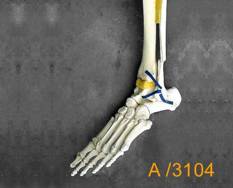 Ankle Large Left – Distal tibia and fibula., Trimalleolar fracture A3104