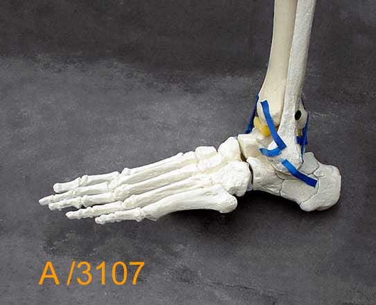 Ankle Large Left – Distal tibia  fracture, Oblique fibula fracture. A3107