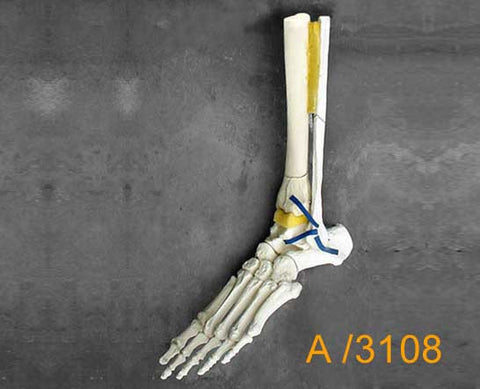 Ankle Large Left – Distal tibial pilon fracture and Oblique fracture of the fibula. A3108