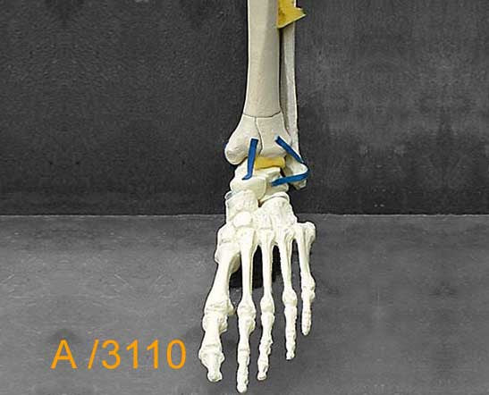 Ankle Large Left – Full length tibia and fibula 4-part Pilon fracture  A3110