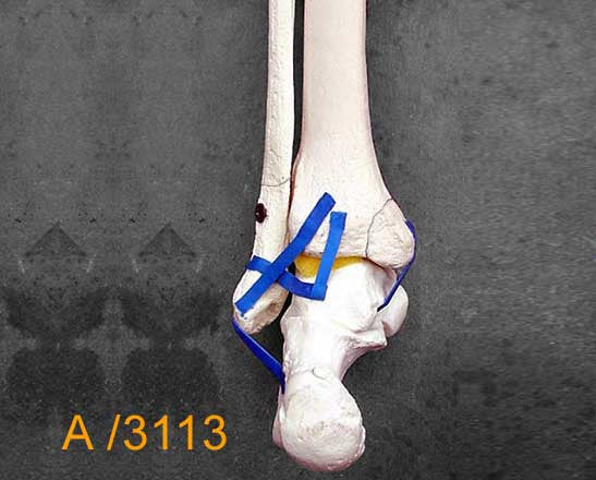 Ankle Large Left – Distal tibia and fibula. with multible fractures A3113