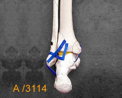 Ankle Large Left – Distal tibia and fibula with type B fracture. A3114