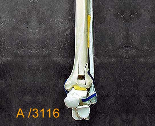 Ankle Large Left – Full length Tib,/Fib distal blowout. A3116