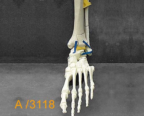 Ankle Large Left Pilon fracture. A3118