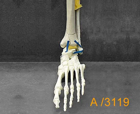 Ankle Large Left Pilon II fracture. A3119