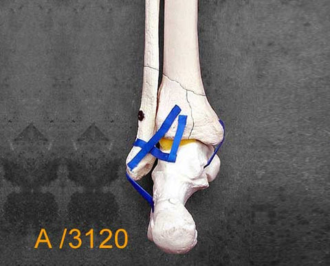 Ankle Large Left – Full length tibia and fibula, Pilon fracture A3120