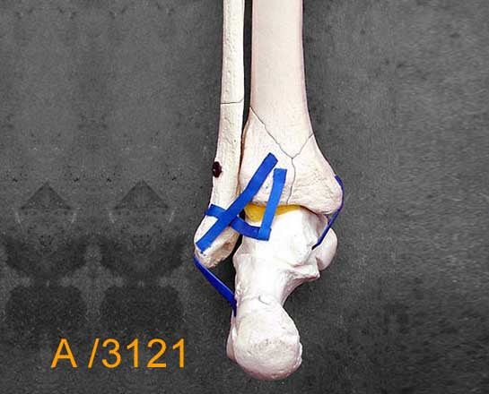Ankle Large Left – Full length tibia and fibula, Weber B fracture  A3121