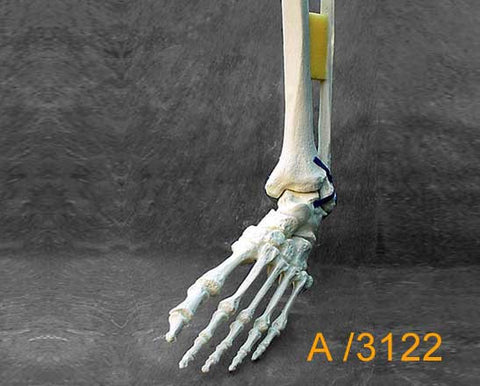 Ankle Large Left – Distal tibia and fibula with varus/sub talr deformity A3122
