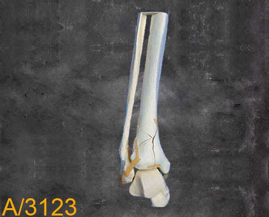 Ankle Large Left –Distal tibia and fibula.Pilon fracture A3123