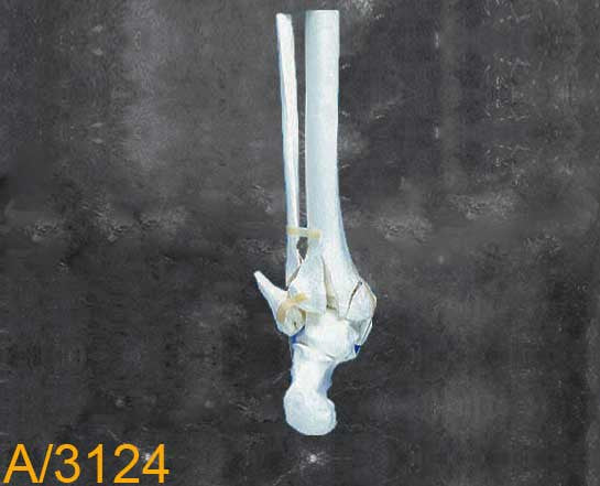 Ankle Large Left –Distal tibia and fibula with mulitble fractures A3124