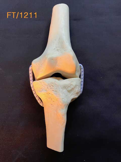 Knee Demo Replacement (Knee)	FT/1211