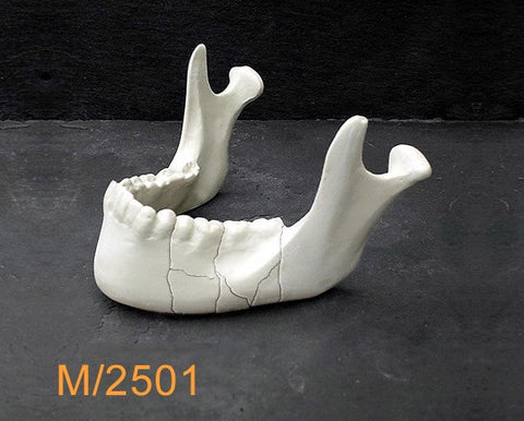 Mandible With commuted fracture M2501