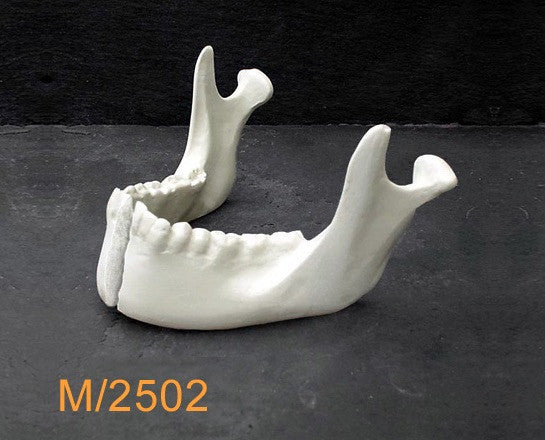 Mandible– With parasymphseal fracture M2502