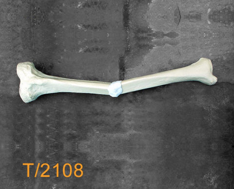 Tibia Large Left Valgus deformity T2108