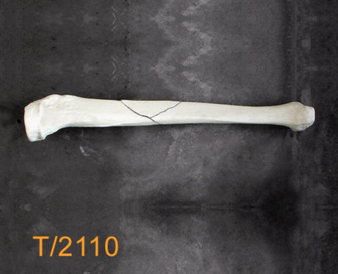 Tibia Large Left butterfly midshaft fracture T2110