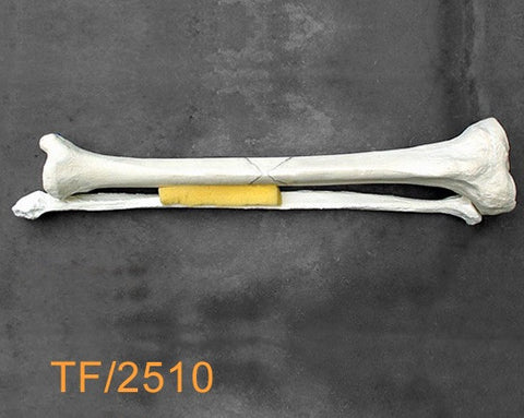 Tibia & Fibula Large Left with butterfly fracture TF2510