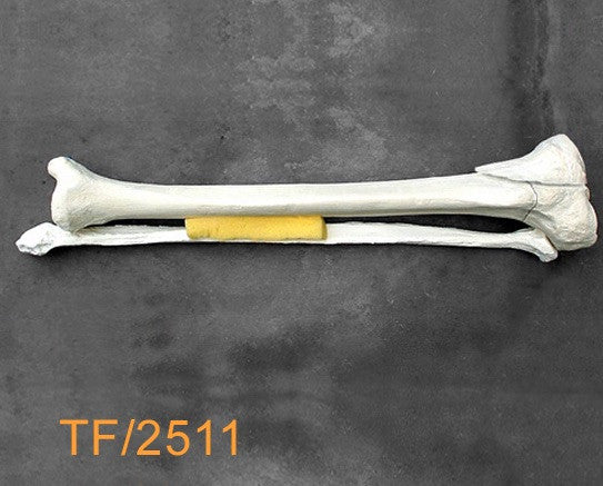 Tibia & Fibula Large Left with plateau fracture TF2511
