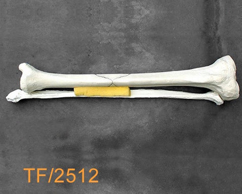 Tibia & Fibula Large Left mid-shaft fracture TF2512