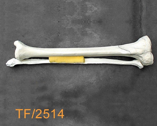 Tibia & Fibula Large Left type 6 plateau fracture TF2514