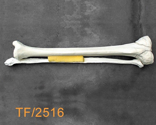 Tibia & Fibula Large Left.bicondylar fracture TF2516
