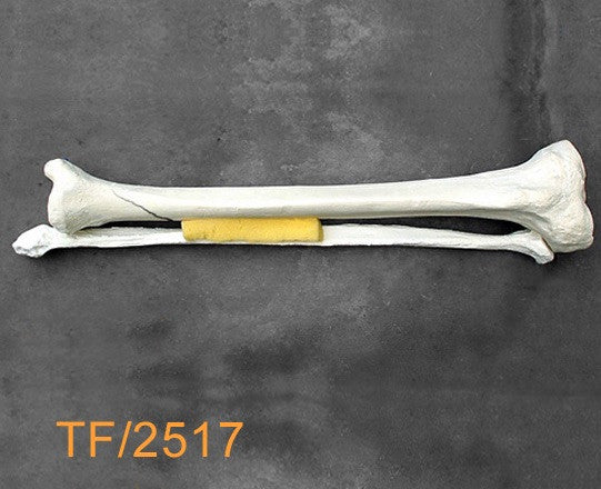 Tibia & Fibula Large Left distal spiral fracture TF2517