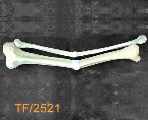 Tibia & Fibula Large Left. Valgus/Procurvatum and mid-shaft malunion TF2521