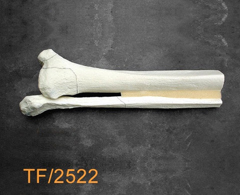 Tibia & Fibula distal with pilon & sagittal fracture TF2522