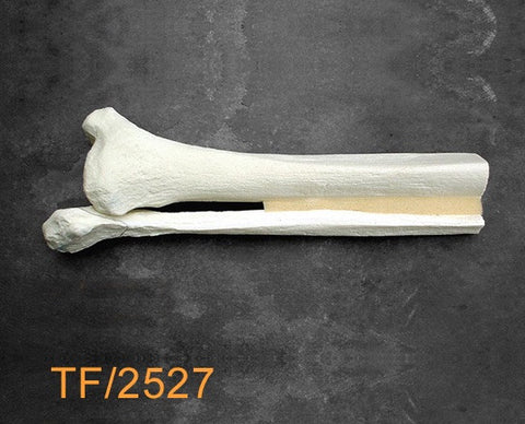 Tibia & Fibula distal half multible fractures TF2527