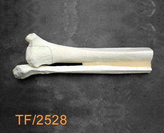 Tibia & Fibula distal half with C fracture TF2528