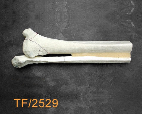 Tibia & Fibula distal half with Pilon fracture TF2529
