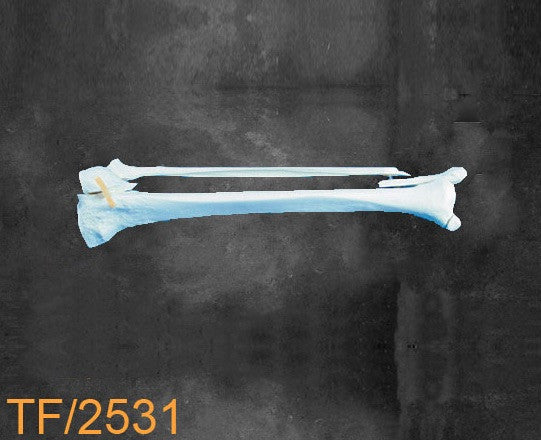 Tibia & Fibula Large Left with multible fractures TF2531