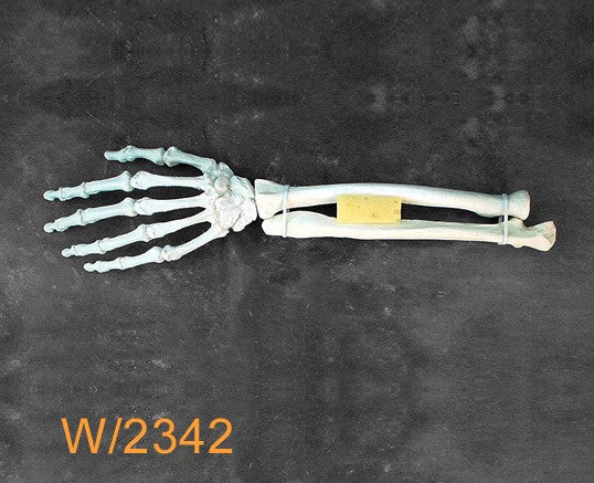 Wrist Large Left hypoplastic ulna W2342