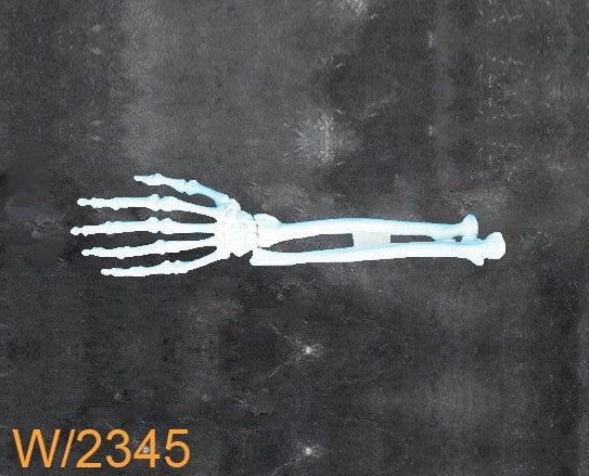 Wrist Large Left distal malunion/dorsal tilt W2345