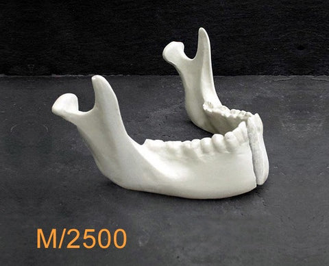 Mandible – With fracture with an avulsion of basal wedge. M2500