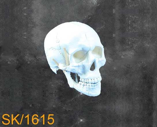 Full Skull - With nasal orbital and zygomatic fracture. SK1615